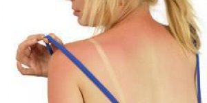 7 astuces pour soulager rapidement un coup de soleil