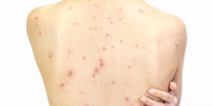 Scarlatine et varicelle : comment faire la difference ?