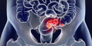 Cancer du colon de stade 2 : le traitement