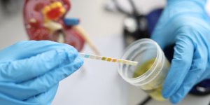 Les americains mettent au point un test urinaire capable de deceler 94 % des cancers de la prostate agressifs