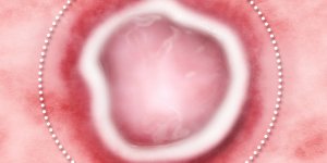 Comment soulager les aphtes ?