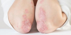 Psoriasis : “Depuis le traitement j’ai enfin la vie dont j’avais reve !”
