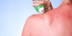 Coup de soleil : l-aloe vera, un bon traitement