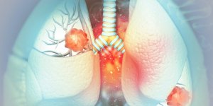 Cancer du poumon : les cas feminins ont augmente de 18 % en 20 ans