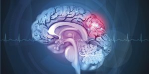 AVC ischemique : la reeducation