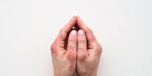 Le psoriasis en 5 questions