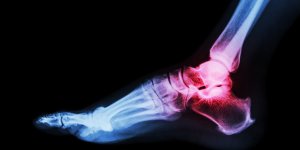 Arthrose du pied : les exercices faciles a faire au quotidien