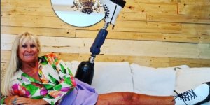 Amputation : comment gerer sa prothese de jambe en ete ?