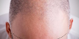 Calvitie : ils font pousser de nouveaux cheveux a partir de cellules humaines