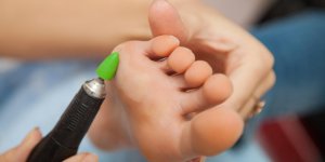 Cors aux pieds : les astuces naturelles