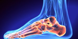 Pied : la fracture du calcaneum