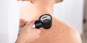 Urticaire cholinergique : les traitements