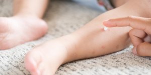 Comment faire disparaitre une allergie aux piqures de moustiques