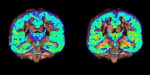 Sur une de ces photos, un cerveau est atteint de la maladie d’Alzheimer