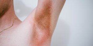 Mycoses (champignons type Candida) de la peau : les medecins europeens tirent la sonnette d-alarme et proposent de nouvelles alternatives therapeutiques
