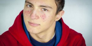 Boutons rouges sur le corps qui ne grattent pas : qu-est-ce que c-est ?
