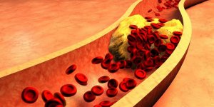 Atherosclerose : 50% des 40-54 ans ont cette maladie sans le savoir