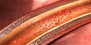 HDL bas : comment faire monter le taux de cette lipoproteine
