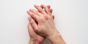 Temoignage : comment mieux vivre au quotidien avec un psoriasis ?
