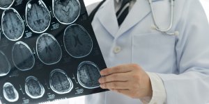 La sotagliflozine contre le diabete est efficace contre les accidents vasculaires