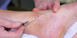 L-anesthesie locoregionale pour le pied