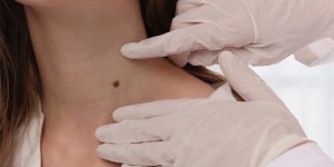 5 taches anormales sur votre corps
