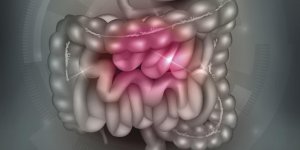 Maladie de l-intestin : le diverticule de Meckel