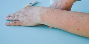 La variole du singe, c’est fini ?