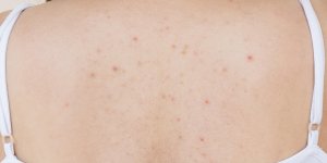 Rubis, petechies : qu-est-ce que ces points rouges sur la peau