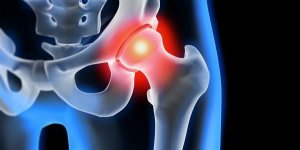Hanche douloureuse : un symptome d-arthrose