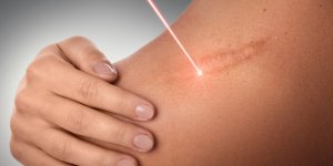 Nos astuces pour camoufler ses cicatrices