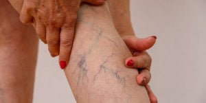 Tout savoir sur la compression medicale