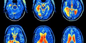 Saignement de nez : quand faire un scanner ?