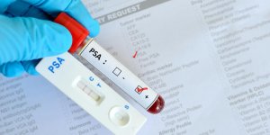 PSA eleve : un signe d-adenome de la prostate ?
