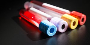 6 raisons cachees qui peuvent augmenter votre taux de creatinine 