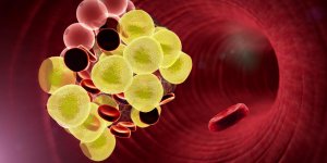 Cholesterol : un facteur de risque de thrombose