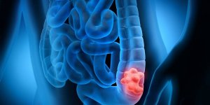 Polypes : 8 choses vraies a savoir absolument