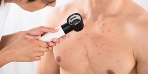 Plaques rouges : un signe d-allergie au chlore ?