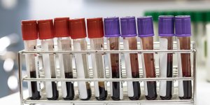 Creatinine ou creatine : la difference