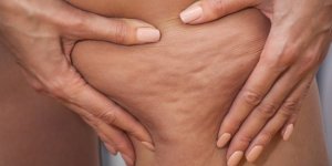 Cellulite : 5 erreurs qui la favorisent