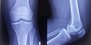 Un test sanguin pour prevoir l-arthrose jusqu-a 8 ans a l-avance