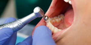 Vous voulez eviter les caries ? Bientot une nouvelle generation de dents chez le dentiste
