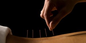 Acupuncture pour maigrir : est-elle remboursee ?