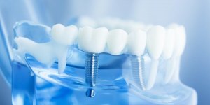 Protheses dentaires : 7 complications possibles si vous en portez