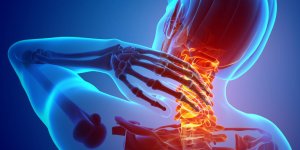 Migraine cervicale et arthrose : le lien