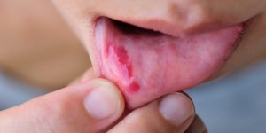 Cancer de la bouche : les non-fumeurs plus a risque ?