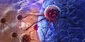 Carcinome basocellulaire : le traitement par therapie photodynamique