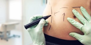 Chirurgie gastrique : qu-est-ce que la gastroplastie ?