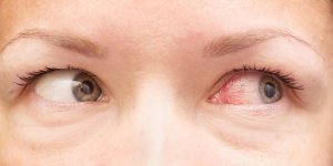 Œil : quelles differences entre la DMLA et le glaucome ?