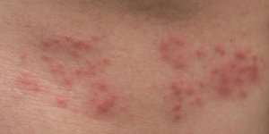 Eruption cutanee au visage : comment reconnaitre un zona ?